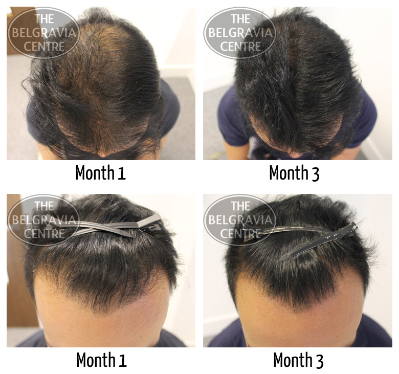 regrow hair after chemical damage